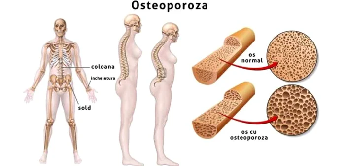 Cum să previi osteoporoza și bolile osoase